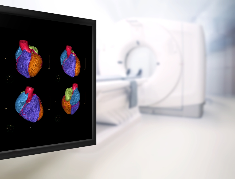 CTA Coronary artery 3D rendering image on the monitor in CT Scanner room