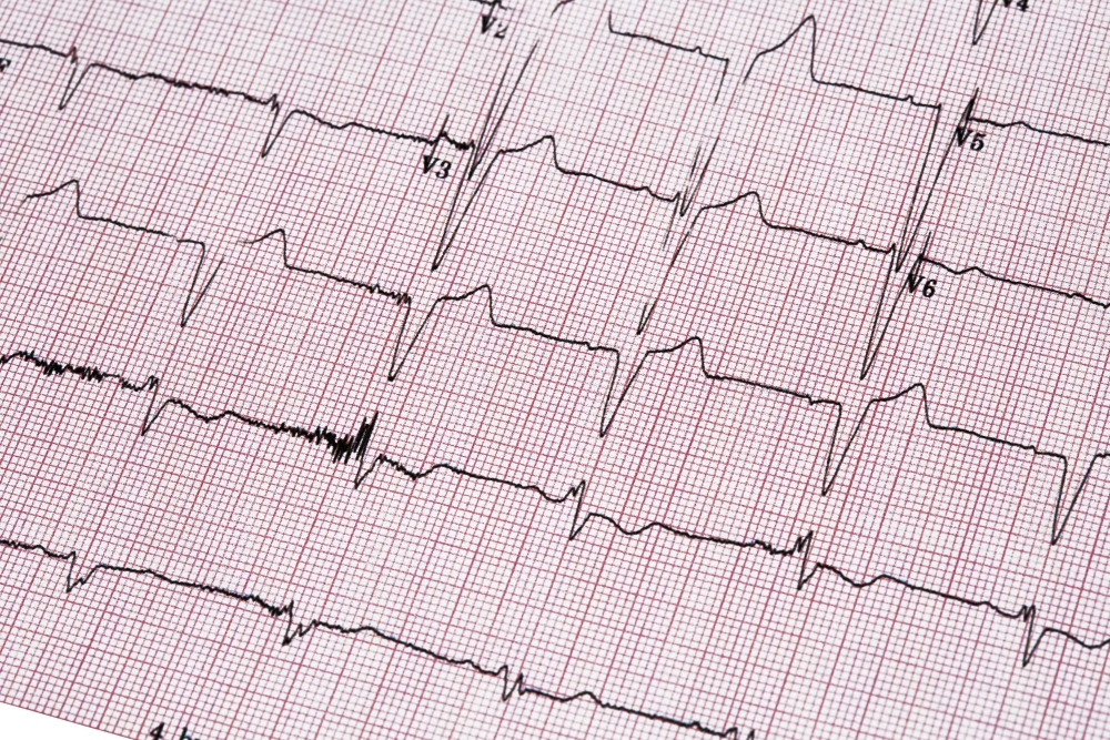 Ecocardiography report ECG showing irregular heartbeat