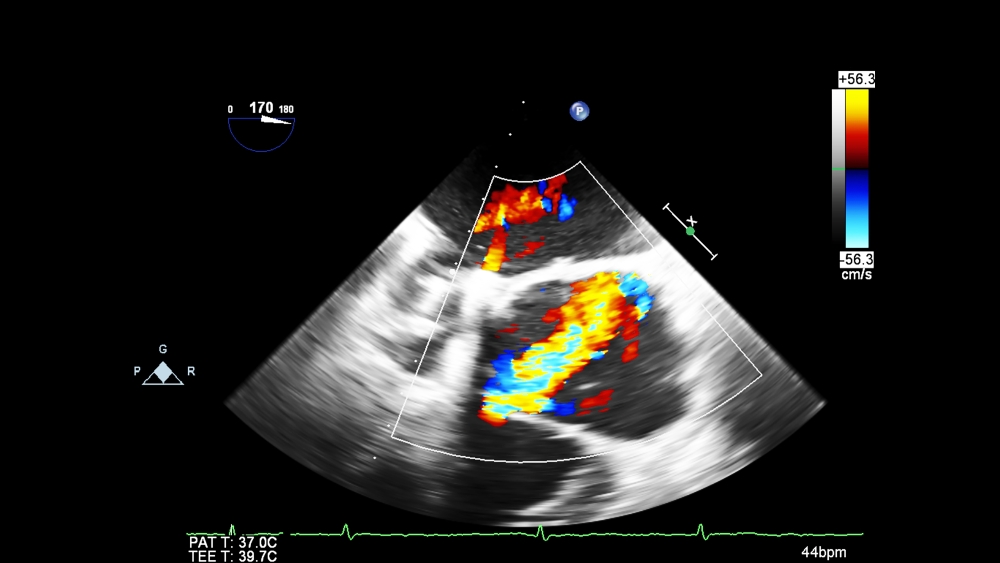 transesophageal ultrasound with Doppler mode