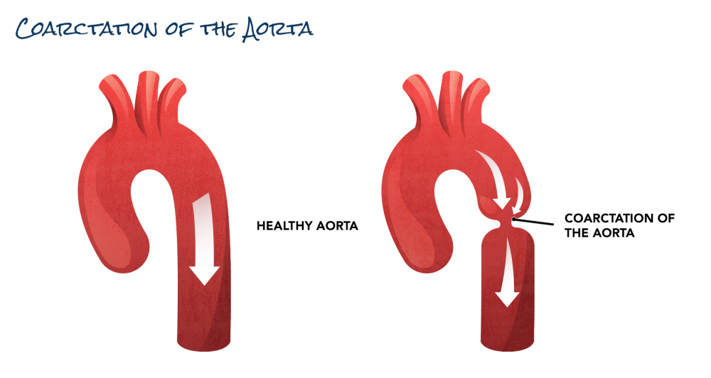 An illustration showing the aorta. A narrowed section is labeled coarctation of the aorta.
