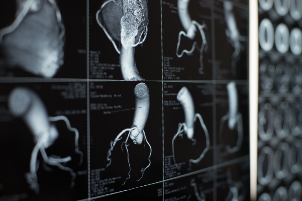 human heart and coronary artery CT images