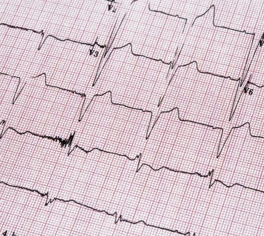 Ecocardiography report ECG showing irregular heartbeat