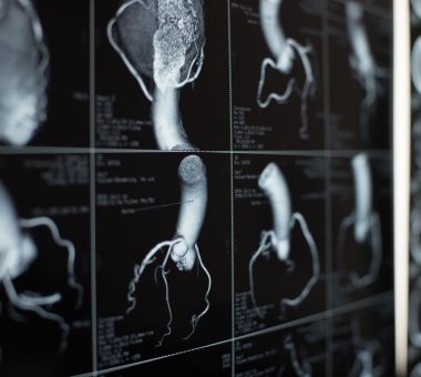human heart and coronary artery CT images