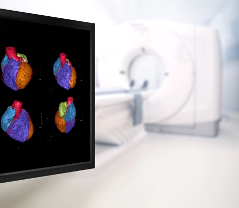 CTA Coronary artery 3D rendering image on the monitor in CT Scanner room