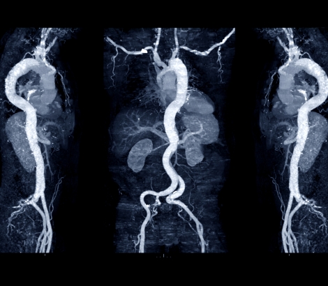 Collection of CTA whole aorta with curve MPR technique showing abdominal aorta and left, right iliac artery showing aortic dissection
