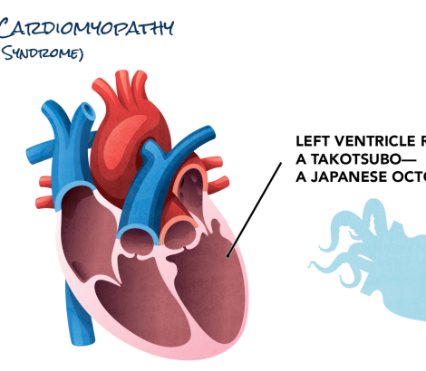 An illustration of Takotsubo cardiomyopathy, or "broken heart syndrome"