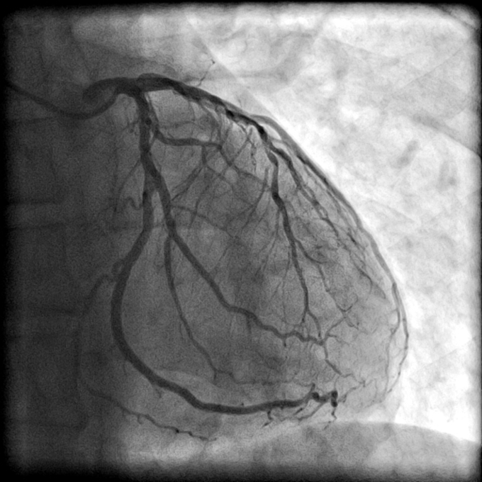 angiography of left coronary artery