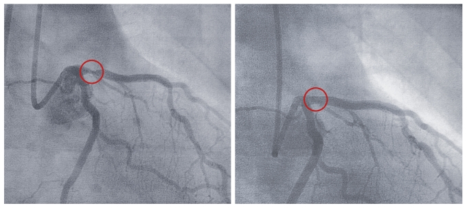 x-ray of cardiac catheterization of the coronary arteries before and after a balloon dilation